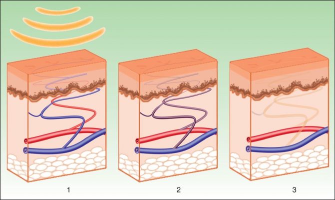 Ánh sáng laser tác động lấy sạch các vi khuẩn sâu dưới da giúp vết mụn nhanh chóng se khít1