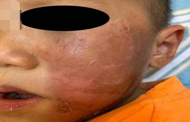 Bé trai 4 tuổi nhập viện trong tình trạng da bỏng rộp1