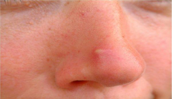 Mũi xuất hiện mụn bọc, mụn mủ là dấu hiệu cảnh báo hệ tiêu hóa của bạn có vấn đề1